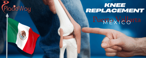 Knee Replacement in Puerto Vallarta, Mexico 2025